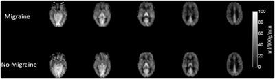 An Arterial Spin Labeling MRI Perfusion Study of Migraine without Aura Attacks